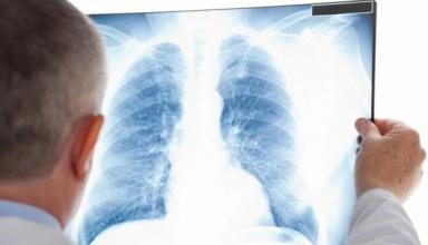 В Украине за месяц обнаружили около тысячи новых больных туберкулезом