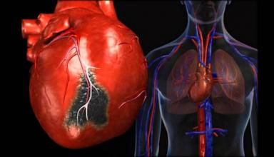Стенокардиия сердца. Что это такое и как это лечить?